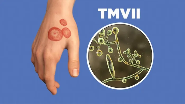 A hand with red, circular ringworm rashes on the skin is shown on a blue background. Next to it is a close-up illustration of ringworm fungus under a microscope. The label “TMVII” appears at the top right of the image.