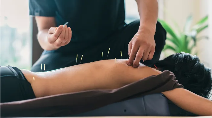 A person lies face down on a table with several thin acupuncture needles inserted along their exposed back. A practitioner’s hands are poised, one placing a needle, with soft natural light and blurred greenery in the background.